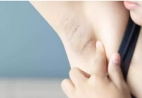 Underarm abscess: causes, symptoms, and fastest treatment