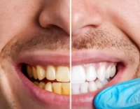What is the reason for changing the color of teeth and the best ways to whiten them?