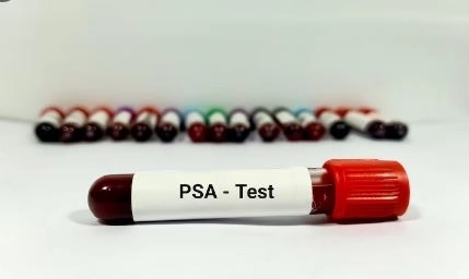 تحليل PSA متى يكون ارتفاعه مؤشر خطر