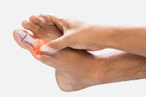 النقرس الكاذب أسبابه وأعراضه وطرق العلاج الفعالة