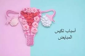 متلازمة تكيّس المبايض (PCOS)