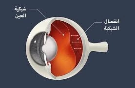 انفصال الشبكية: الأعراض المبكرة وطرق العلاج الجراحي  مع د. ثري عبد الحليم غيط