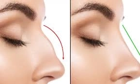  تجميل الأنف بين الجراحة والتقنيات غير الجراحيةمع د. ياسمين بركات