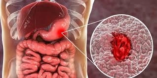 قرحة المعدة: الأعراض و الأسباب والعلاج النهائي من مستشفى التخصصي