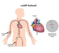 هل القسطرة القلبية تغني عن جراحات القلب المفتوح مع مركز القلب والصدر