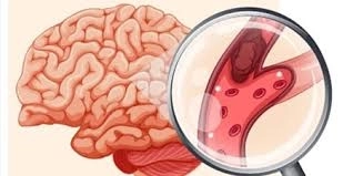 الجلطات الدماغية: تقليل المضاعفات بعد الإصابة مع د. هشام الحناوي