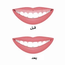 بوتكس وفيلر في طب الأسنان مع Dental Land: لماذا يُستخدم ومتى يُنصح به؟