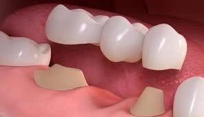 متى نختار التركيبات الثابتة؟ ومتى تُفضل المتحركة؟ دكتور مؤمن سرحان 