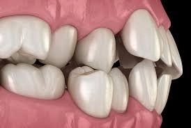تصحيح الأسنان غير المتناسقة مع د. إسلام نبيل حامد