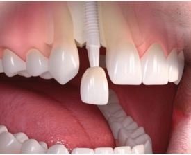 زراعة الأسنان الحل الأمثل لابتسامتك مع دكتورة ريهام قطب