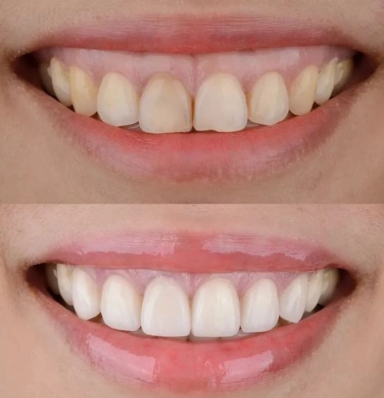 علاج الابتسامة اللثوية مع دكتورة ريهام قطب:جمال ابتسامتك