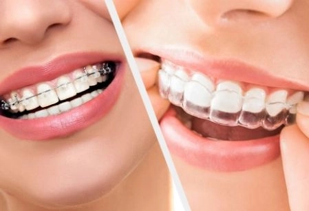 تقويم الأسنان الثابت والمتحرك: دليلك مع دكتور عبد الرحمن 