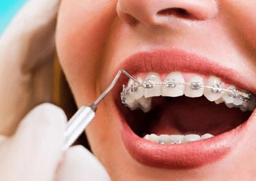 تقويم الأسنان – خطوات وتصحيح الابتسامة مع دكتور يوسف أيمن
