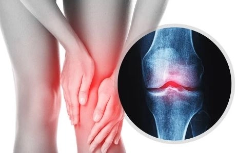 جراحات الركبة: الأنواع والتقنيات الحديثة