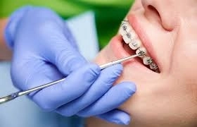تقويم الأسنان لعلاج مشاكل الأسنان والفكين مع مركز تاج لطب الأسنان