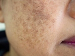 دكتورة دينا عاطف وعلاج التصبغات الجلدية