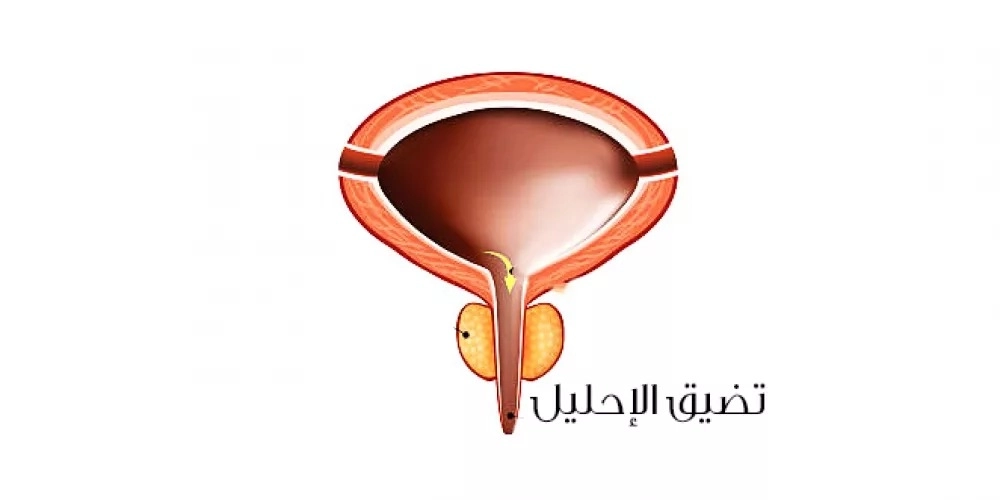 دكتور محمد المعداوي يوضح أسباب ضيق مجرى البول