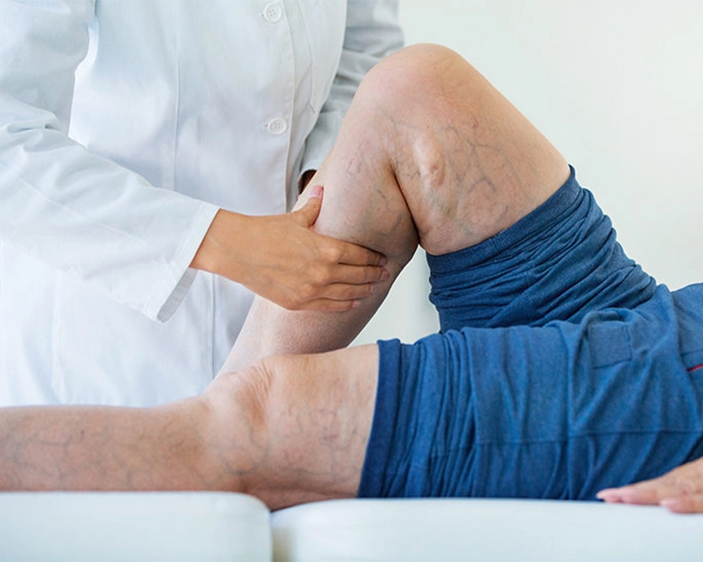 علاج دوالي الساقين بطرق حديثة وآمنة مع دكتور رفيق عدلى ويصا :