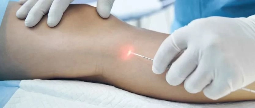 علاج الدوالي بالليزر بدون تدخل جراحي مع مركز اى فين :