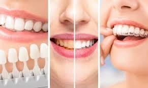 تجميل الأسنان لتحسين شكل الابتسامة مع دكتور محمود الجيار