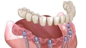 التركيبات الثابتة والمتحركة لاستعادة جمال الأسنان مع دكتور شريف عشماوي