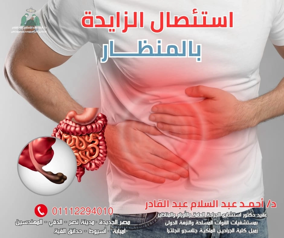 استئصال الزائدة بالمنظار. مع دكتور احمد عبد السلام 