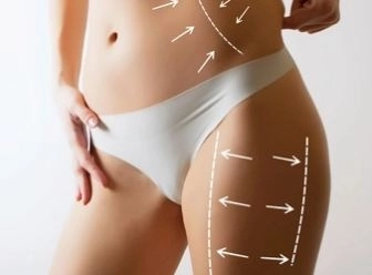شفط الدهون بالفيزر 4D لإعادة تشكيل القوام مع دكتور ياسر عبد الخالق