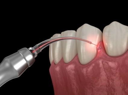 تجميل الأسنان بالليزر وعدسات الفينير – تؤكد عليه دكتورة علياء الفقي