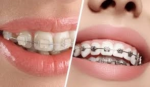 تقويم الأسنان المعدني والشفاف – مع عيادات تكنو كلينك للأسنان تقويم الأسنان المعدني والشفاف – مع عيادات تكنو كلينك للأسنان