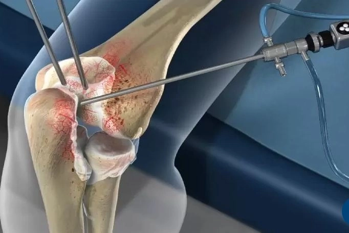 مناظير المفاصل وأهميتها في علاج إصابات العظام مع دكتور فادى فارس 