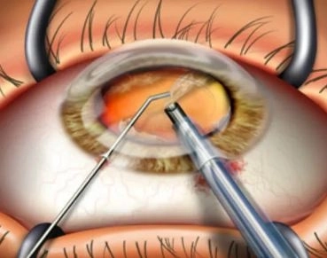 جراحات المياه البيضاء بالفاكو دقة وأمان مع دكتور احمد رسمى عامر