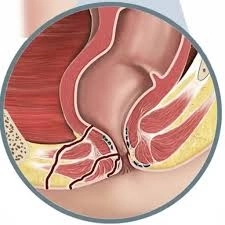 جراحات الشرج والبواسير والناسور الشرجي مع دكتور أحمد طلحة جراحات الشرج والبواسير والناسور الشرجي مع دكتور أحمد طلحة