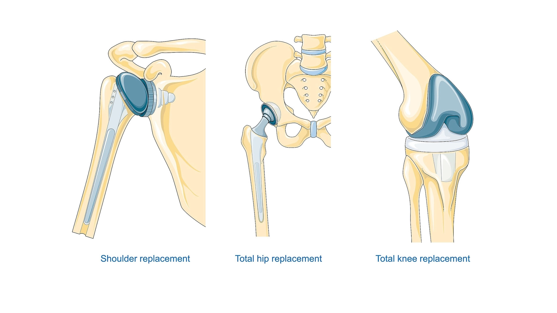  استبدال المفاصل الصناعية للركبة والورك مع دكتور أحمد رزق عليوة