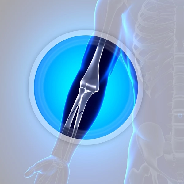 جراحات العظام والكسور المعقدة مع دكتور أحمد رزق عليوة
