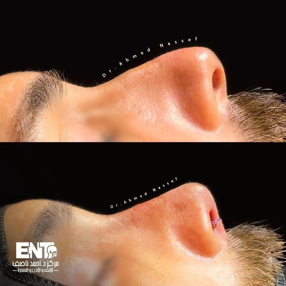 د كتور أحمد ناصف و تجميل الأنف