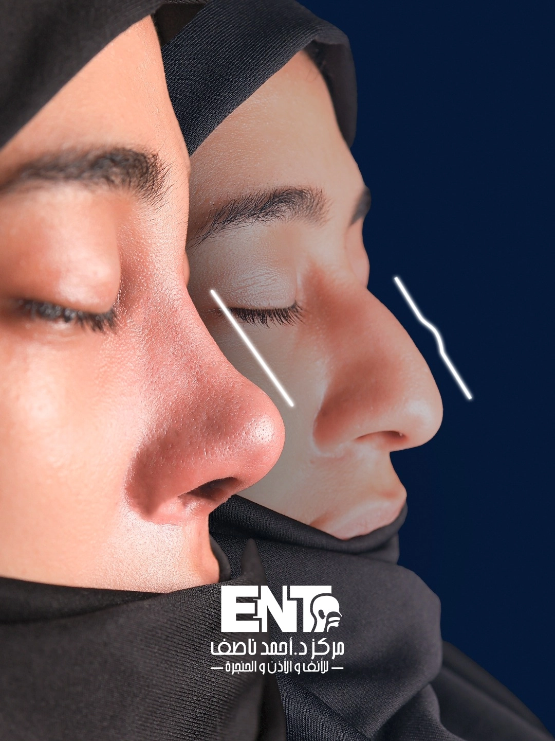 دكتور أحمد ناصف أفضل اختيار لتجميل الأنف الوظيفي والجمالي 