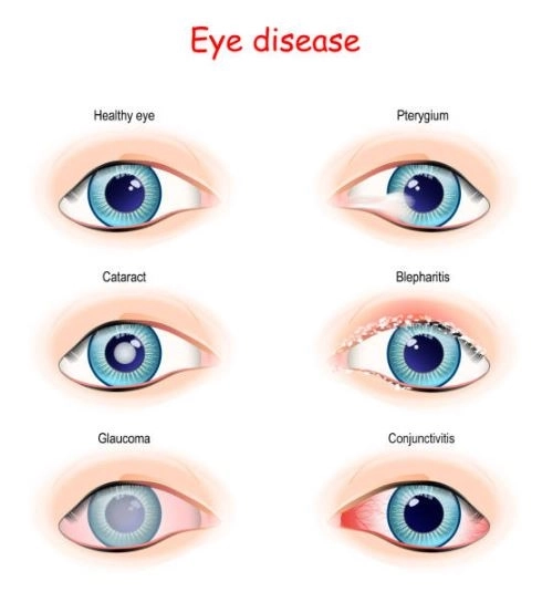 أمراض العيون المزمنة: طرق الوقاية والعلاج مع دكتور عبد الحميد خليف أمراض العيون المزمنة: طرق الوقاية والعلاج مع دكتور عبد الحميد خليف