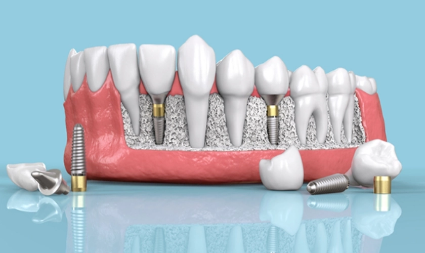 زراعة الأسنان بأحدث التقنيات: مع دكتور احمد عبد الغنى شرارة زراعة الأسنان بأحدث التقنيات: مع دكتور احمد عبد الغنى شرارة
