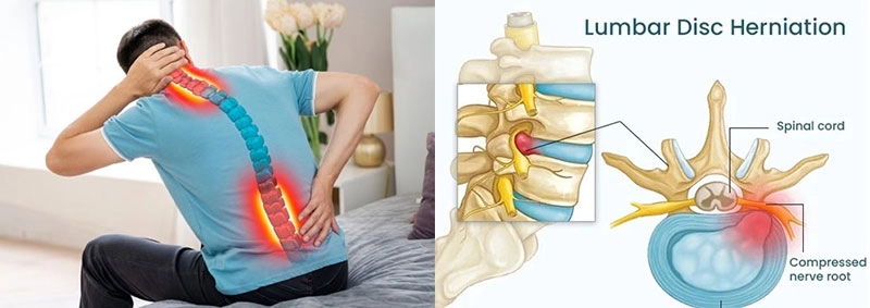 علاج الانزلاق الغضروفي العنقي والقطني مع دكتور محمد محسن محمد