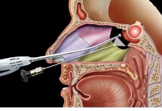 جراحة الغدة النخامية بالمنظار مع دكتور محمد حلمى عبد الشفوق