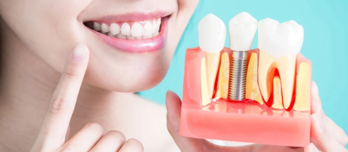 زراعة الأسنان بأحدث التقنيات الحديثة مع دكتور عمار زراعة الأسنان بأحدث التقنيات الحديثة مع دكتور عمار