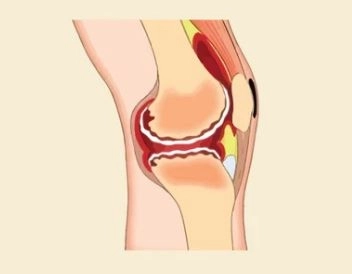 الروماتيزم: أسبابه وأعراضه وأنواعه مع دكتور محمد السودة 