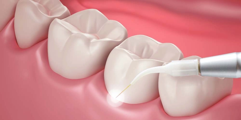 علاج أمراض اللثة: دليلك الشامل مع دكتور وليد ناصر العبيدى 