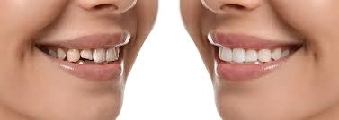 تجميل الابتسامة وتصحيح شكل الأسنان مع دكتور محمود سعيد