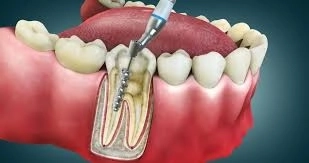 علاج وحشو العصب بأحدث التقنيات في طب الأسنان مع دكتور اسلام داوود