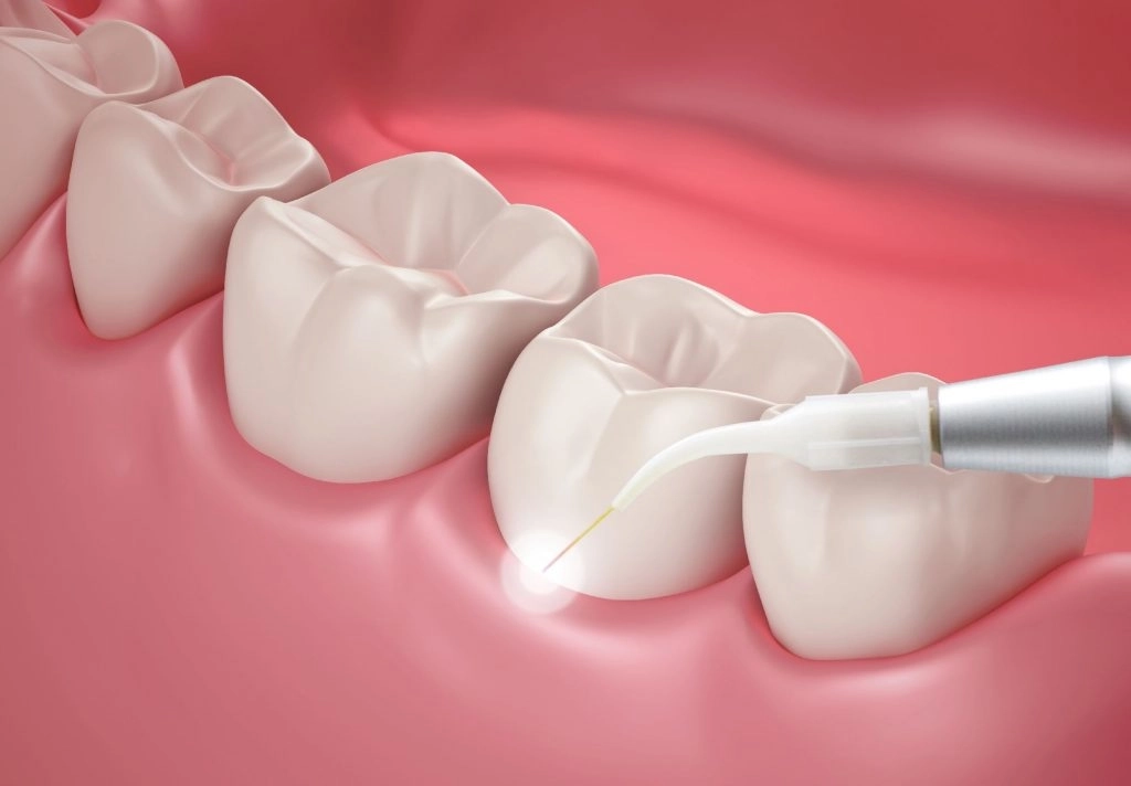 تجميل الأسنان بالليزر: الابتسامة المثالية مع دكتور اشرف الدلجاوى تجميل الأسنان بالليزر: الابتسامة المثالية مع دكتور اشرف الدلجاوى