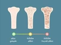 هشاشة العظام وطرق الوقاية مع د محمد حسن أبوزيد هشاشة العظام وطرق الوقاية مع د محمد حسن أبوزيد