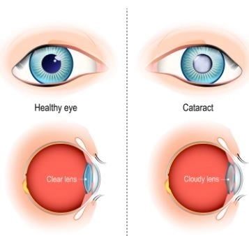 المياه البيضاء (Cataract): الأسباب، الأعراض مع دكتور طارق عبد الرازق 