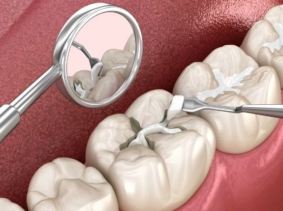 علاج تسوس الأسنان والحشوات مع دكتورة هويدا مهران 
