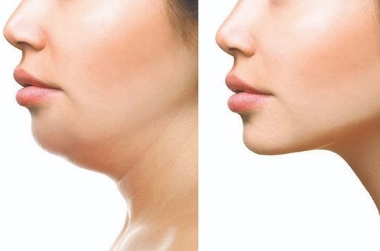 جراحة تجميل الذقن وعظام الوجه: الحل المثالي مع دكتور ياسر الشيخ